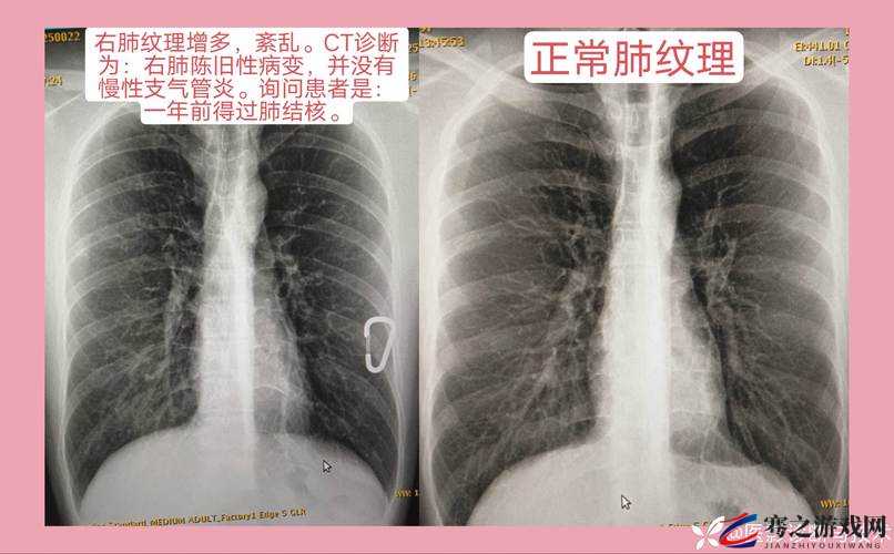 100 胸片曝光率 2024：医学影像的关键指标